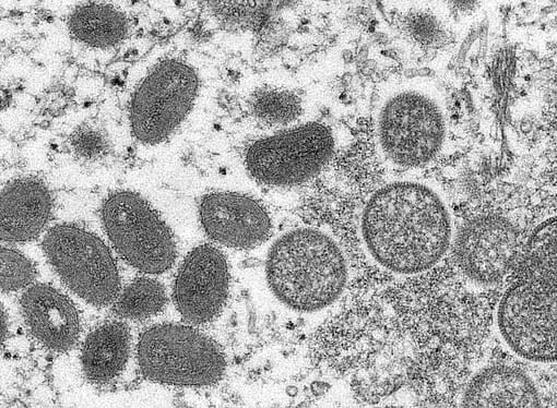 Belgium Initiates 21 Day Quarantine For Those With Monkeypox